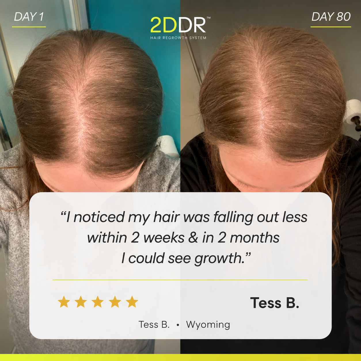 Advanced Hair Formula | 3 Month Supply | Free Derma Roller + Free US Shipping