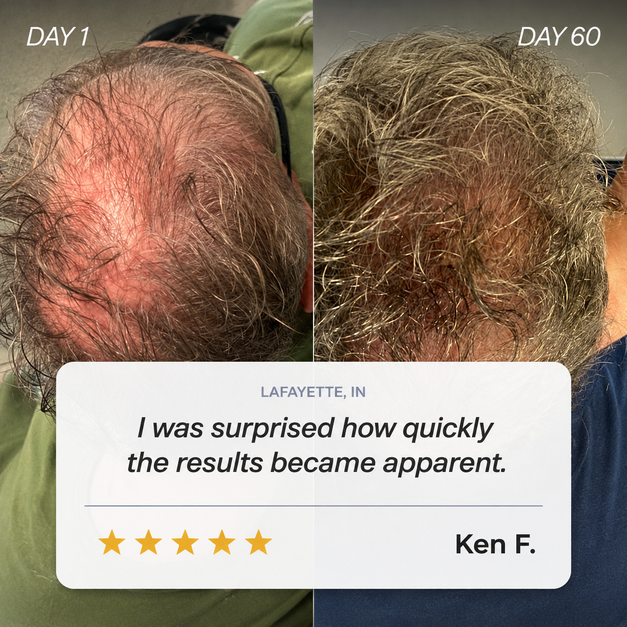 Advanced Hair Formula | 3 Month Supply | Free Derma Roller + Free US Shipping
